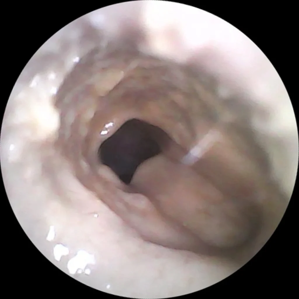 cerumen despues de gotas