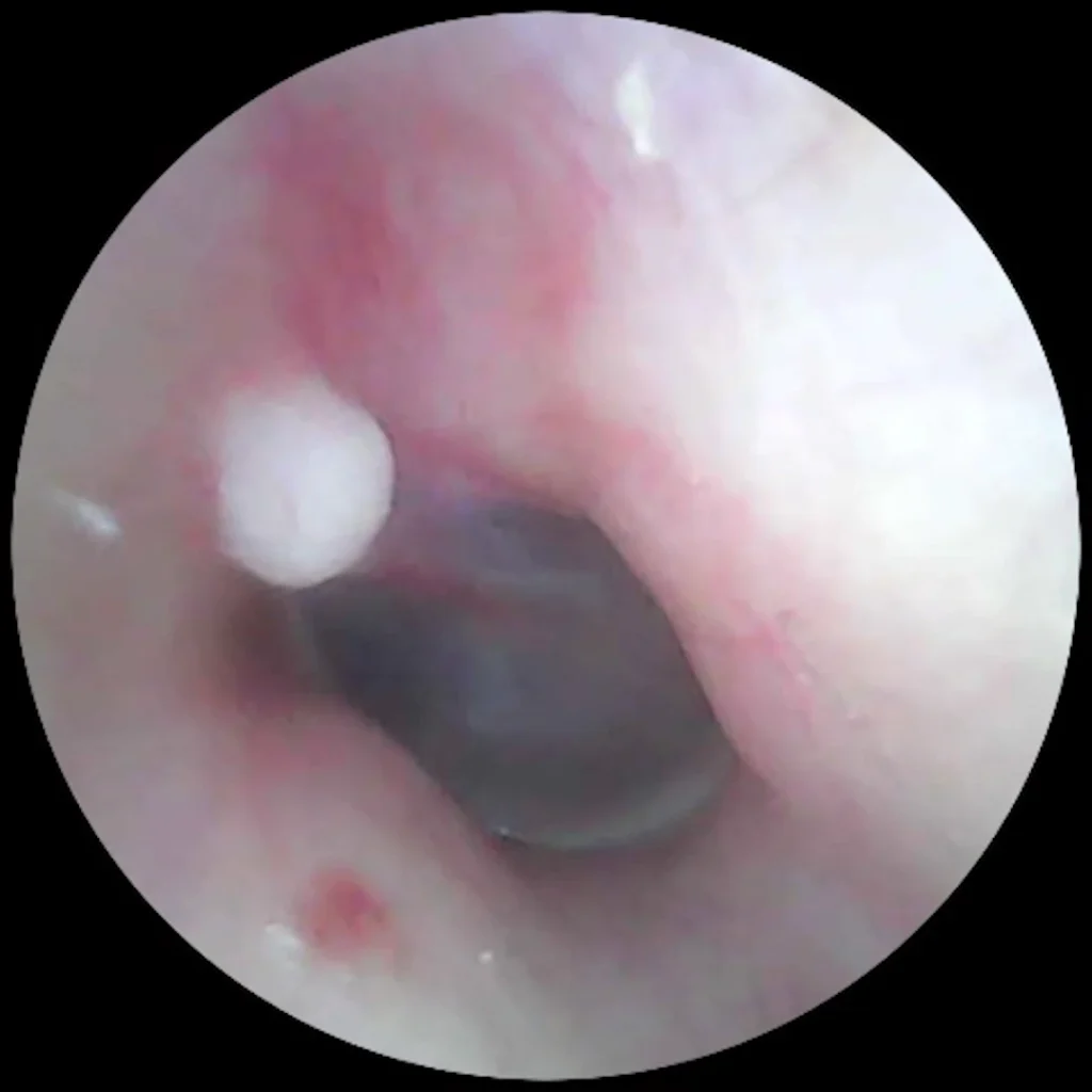 Exostosis y tapón de cerumen