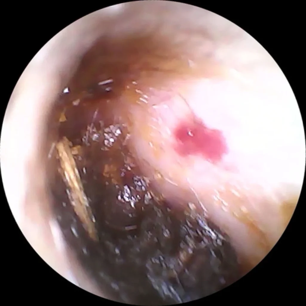 cerumen con herida en cae