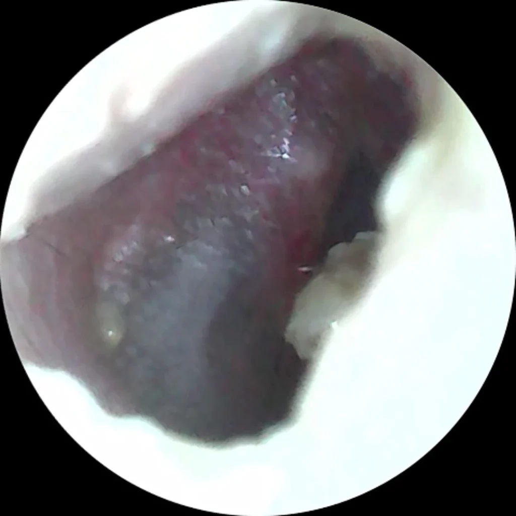 otitis externa + media
